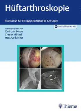 Sobau / Möckel / Gollwitzer |  Hüftarthroskopie - Mängelexemplar, kann leichte Gebrauchsspuren aufweisen. Sonderangebot ohne Rückgaberecht. Nur so lange der Vorrat reicht. | Buch |  Sack Fachmedien