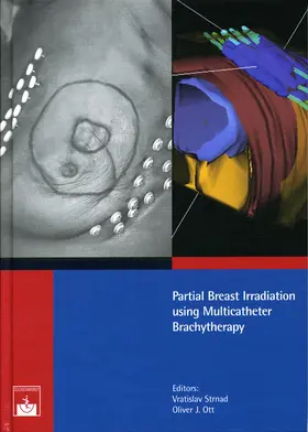Strnad |  Partial Breast Irradiation using Multicatheter Brachytherapy | eBook | Sack Fachmedien
