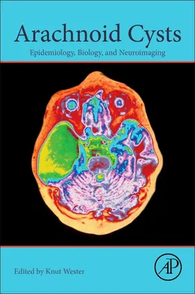 Wester |  Arachnoid Cysts | Buch |  Sack Fachmedien