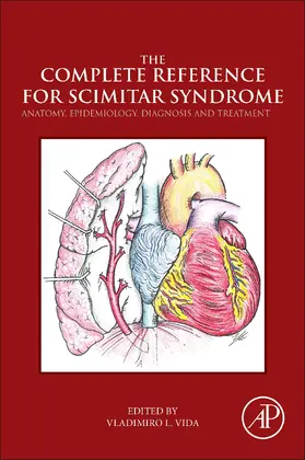 Vida |  The Complete Reference for Scimitar Syndrome | eBook | Sack Fachmedien