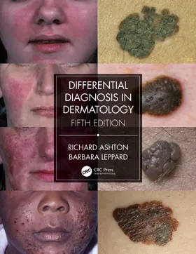 Ashton / Leppard |  Differential Diagnosis in Dermatology | Buch |  Sack Fachmedien