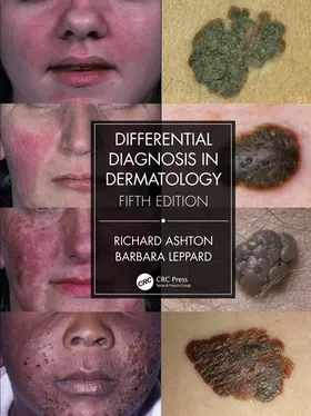 Ashton / Leppard |  Differential Diagnosis in Dermatology | Buch |  Sack Fachmedien