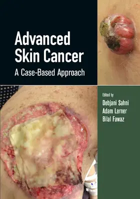 Lerner / Sahni |  Advanced Skin Cancer | Buch |  Sack Fachmedien