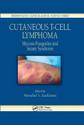 Zackheim | Cutaneous T-Cell Lymphoma | Buch | 978-0-367-39367-0 | www2.sack.de