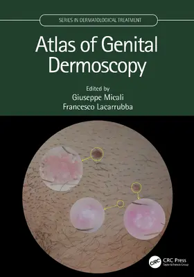 Micali / Lacarrubba |  Atlas of Genital Dermoscopy | Buch |  Sack Fachmedien