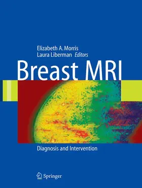 Liberman |  Breast MRI | Buch |  Sack Fachmedien