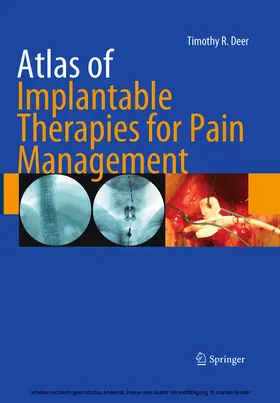 Deer |  Atlas of Implantable Therapies for Pain Management | eBook | Sack Fachmedien