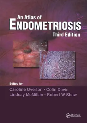 Overton / Shaw / McMillan |  Atlas of Endometriosis | Buch |  Sack Fachmedien