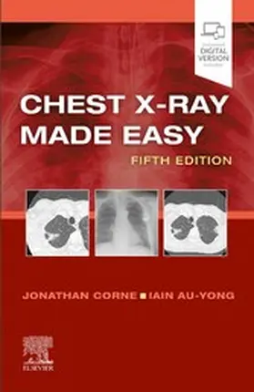 Corne / Au-Yong MA / Au-Yong |  Chest X-Ray Made Easy E-Book | eBook | Sack Fachmedien