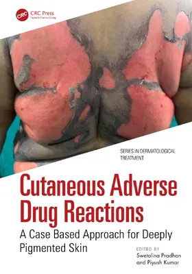 Kumar / Pradhan |  Cutaneous Adverse Drug Reactions | Buch |  Sack Fachmedien