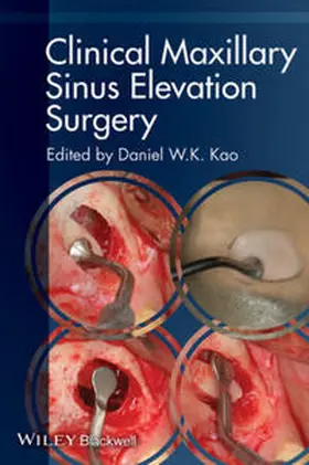 Kao | Clinical Maxillary Sinus Elevation Surgery | E-Book | www2.sack.de