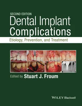 Froum |  Dental Implant Complications | Buch |  Sack Fachmedien