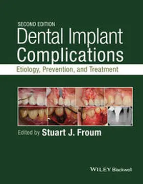 Froum |  Dental Implant Complications | eBook | Sack Fachmedien