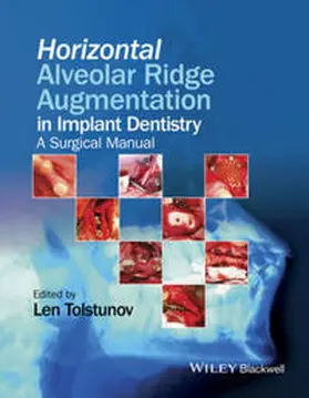 Tolstunov |  Horizontal Alveolar Ridge Augmentation in Implant Dentistry | Buch |  Sack Fachmedien