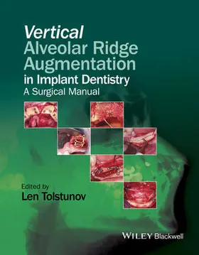 Tolstunov | Vertical Alveolar Ridge Augmentation in Implant Dentistry | Buch | 978-1-119-08259-0 | sack.de