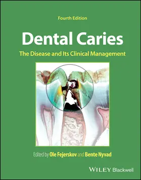 Fejerskov / Nyvad |  Dental Caries | Buch |  Sack Fachmedien