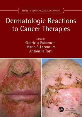 Fabbrocini / Lacouture / Tosti |  Dermatologic Reactions to Cancer Therapies | Buch |  Sack Fachmedien