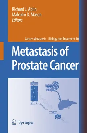 Ablin / Mason |  Metastasis of Prostate Cancer | Buch |  Sack Fachmedien