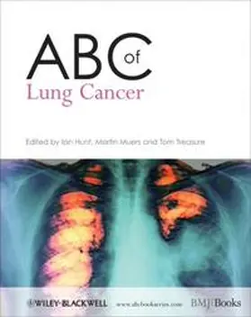 Hunt / Muers / Treasure |  ABC of Lung Cancer | eBook | Sack Fachmedien