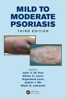 Koo / Levin / Leon |  Mild to Moderate Psoriasis | Buch |  Sack Fachmedien