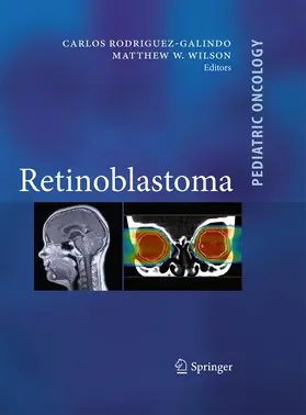 Wilson / Rodriguez Galindo |  Retinoblastoma | Buch |  Sack Fachmedien