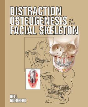 Bell |  Distraction Osteogenesis of the Facial Skeleton | Buch |  Sack Fachmedien