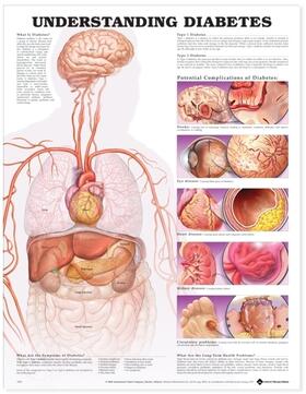  Understanding Diabetes Anatomical Chart | Sonstiges |  Sack Fachmedien