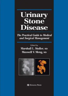 Stoller / Meng |  Urinary Stone Disease | eBook | Sack Fachmedien