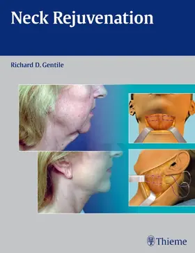 Gentile |  Neck Rejuvenation | Buch |  Sack Fachmedien