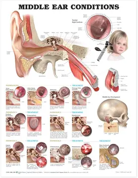  Middle Ear Conditions Anatomical Chart | Sonstiges |  Sack Fachmedien