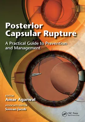 Agarwal |  Posterior Capsular Rupture | Buch |  Sack Fachmedien