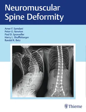 Samdani / Newton / Sponseller |  Neuromuscular Spine Deformity | eBook | Sack Fachmedien