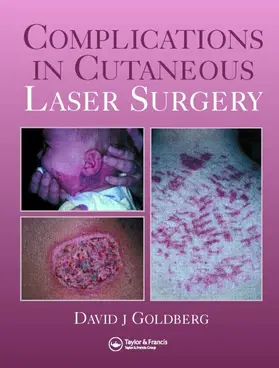 Goldberg | Complications in Laser Cutaneous Surgery | Buch | 978-1-84184-245-5 | www2.sack.de