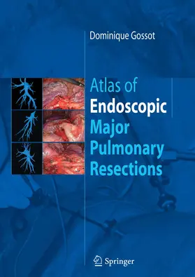 Gossot | Atlas of endoscopic major pulmonary resections | E-Book | www2.sack.de