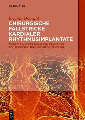 Osswald |  Chirurgische Fallstricke kardialer Rhythmusimplantate | Buch |  Sack Fachmedien