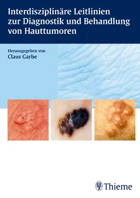 Garbe / Reimann |  Interdisziplinäre Leitlinien zur Diagnostik und Behandlung von Hauttumoren | eBook | Sack Fachmedien
