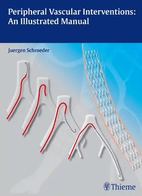 Schröder |  Peripheral Vascular Interventions: An Illustrated Manual | Buch |  Sack Fachmedien