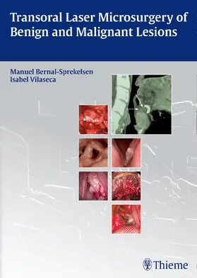 Bernal-Sprekelsen / Vilaseca |  Transoral Laser Microsurgery of Benign and Malignant Lesions | Buch |  Sack Fachmedien