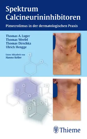 Luger / Dirschka / Hengge |  Spektrum Calcineurininhibitoren: Pimecrolimus in der dermatologischen Praxis | Buch |  Sack Fachmedien