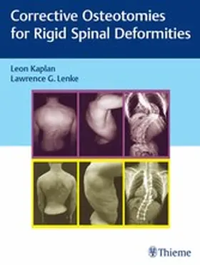 Kaplan / Lenke | Corrective Osteotomies for Rigid Spinal Deformities | E-Book | www2.sack.de