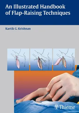 Krishnan | An Illustrated Handbook of Flap-Raising Techniques | E-Book | sack.de
