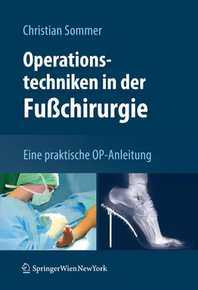 Sommer |  Operationstechniken in der Fußchirurgie | Buch |  Sack Fachmedien