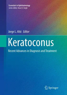 Alió |  Keratoconus | Buch |  Sack Fachmedien
