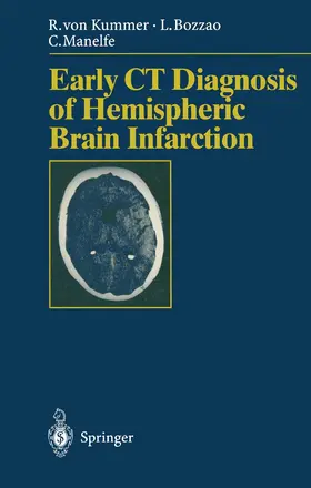 Kummer / Bozzao / Manelfe |  Early CT Diagnosis of Hemispheric Brain Infarction | Buch |  Sack Fachmedien