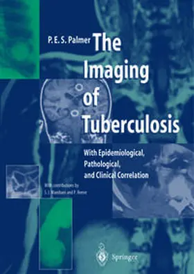 Palmer | The Imaging of Tuberculosis | E-Book | sack.de