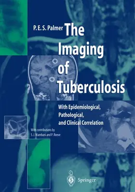 Palmer |  The Imaging of Tuberculosis | Buch |  Sack Fachmedien