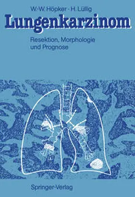 Höpker / Lüllig |  Lungenkarzinom | eBook | Sack Fachmedien