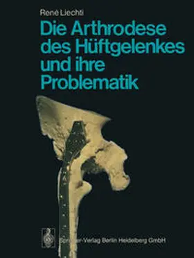 Liechti |  Die Arthrodese des Hüftgelenkes und ihre Problematik | eBook | Sack Fachmedien