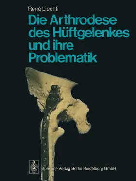 Liechti |  Die Arthrodese des Hüftgelenkes und ihre Problematik | Buch |  Sack Fachmedien