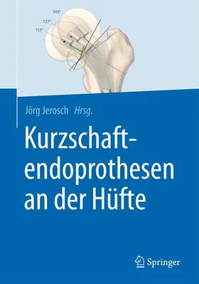 Jerosch |  Kurzschaftendoprothesen an der Hüfte | Buch |  Sack Fachmedien